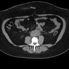 Check spelling or type a new query. Retroperitoneal Fibrosis Radiology Case Radiopaedia Org