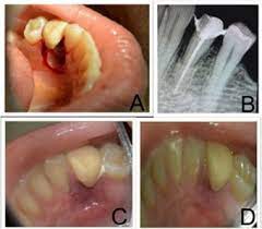 Lateral Periodontal Cyst A Diagnostic Dilemma Report Of A Rare Case With Cbct And Histological Findings Sciencedirect