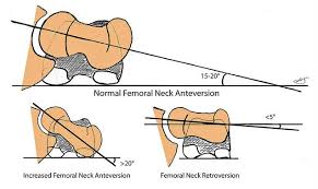Image result for Femoral Retroversion