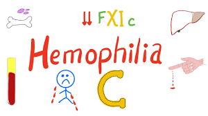 Genes variations tissues related diseases publications pathways symptoms & phenotypes drugs. Hemophilia C Factor Xi Deficiency Youtube