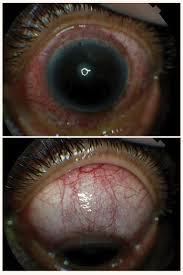 Image result for Scleritis