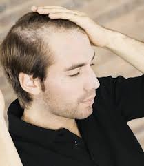 While hair loss at a young age can be alarming, it's important to remember that the earlier thinning hair is noticed and any potential issue is diagnosed, the easier it may be to treat. What Can My Young Boyfriend Do About His Hair Loss