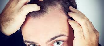 This medicine is not for use in women. Medical Treatment Methods For Hair Loss Maral Hair