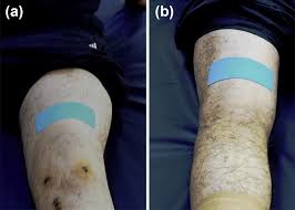 Common injuries such as runner's knee or patella tendonitis, jumper's knee, patella tracking, arthritis, meniscus tears, plica, patellofemoral pain, and general instability can all be best addressed by using the kt tape full knee support application*. Sham Kinesio Tape Application On The A Front And B Back Side Of The Download Scientific Diagram