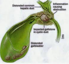 Apple juice tends to be gentler on the body compared with lemon juice and juice made of epsom salts. Shiningsoul 6 Days Apple Juice Treatment To Remove Gallstones Naturally