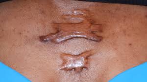 How do i get rid of a keloid. Keloid Scars Symptoms Causes And Treatments