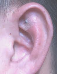 Ear Acupuncture