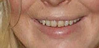 De coronacijfers zijn, na 16 weken stabiliteit (weliswaar op een hoog niveau), niet goed aan het evolueren. Foto Lindsay Lohans Tanden Rotten Door Drugs Het Nieuwsblad Mobile