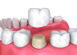 Dental Crowns: The All-In-One Solution For Your Damaged Teeth - Soft Touch  Dental