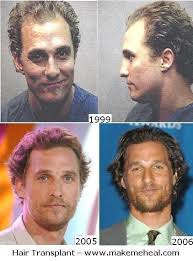 Matthew Mcconaughey Hair Transplant Yay Or Nay Haircuts For Balding Men Hair Transplant Procedure Hairline Transplant