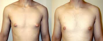 All About Male Breast Reduction Surgery | J. Brian Boyd, M.D.