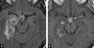 Старовойтова м.н., десинова о.в., конева о.а. Cerebral Tumor Or Pseudotumor Sciencedirect