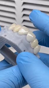 This case involved a, no-prep temporary bridge, resulting in a very thin restoration due to limited space., During the finishing stage,, repeated fractures occurred under brushing and polishing,, ...