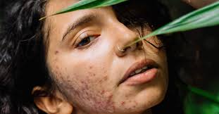 Image result for acne face