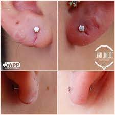 Piercing Through Scar Tissue