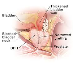 Maybe you would like to learn more about one of these? Prostate Problems And Related Urinary Symptoms Saint Luke S Health System