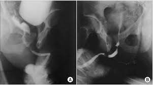 Image result for Retrograde Urethrogram