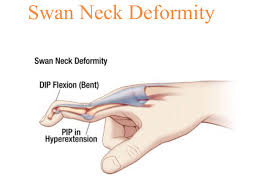Swan Neck Deformity Hand Therapy Medicine Internal Medicine