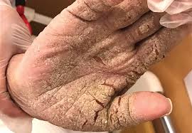 Image result for scabies norvegica