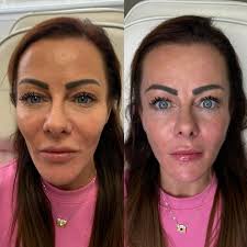 Full face rejuvenation is my most popular treatment in clinic 💉✨ This  includes 5 syringes of filler where needed to create a natural and  refreshed result. The before and afters are my