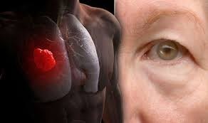 Justanswer.com has been visited by 100k+ users in the past month Lung Cancer Symptoms Signs Of A Tumour Include Having Droopy Eyelids Express Co Uk