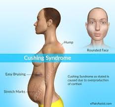 Cushing S With Moxie Fighting The Worst Disease You Ve Never Heard Of Comprehensive List Of Cushing S Sympt Cushings Syndrome High Cortisol Symptoms Cushings