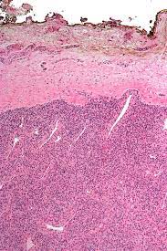 After i did that, they performed an ultrasound on that breast. Resection Margin Wikipedia