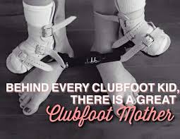 Club Foot Boots And Bar Club Foot Baby Club Foot Baby Footies