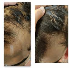 4.9 pcos hair loss is reversible how to treat with it i had used minoxidil for a one & hair loss is increased? How To Stop My Pcos Hair Fall And Regrow Fallen Hair I Have Lost Lots Of Hair And My Scalp Is Almost Visible I Am Very Much Scared Now Can Someone Suggest