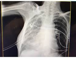 Um raio x também pode mostrar coleções fluidas anormais que também podem. Manejo Do Derrame Pleural No Departamento De Emergencia De Emergencia Rules