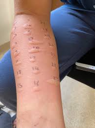 My 12 year old, allergic to nearly everything