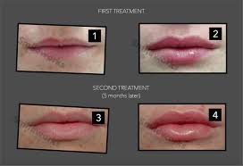 Lip Fillers Gone Wrong Dissolve Filler With Hyalase Advice Cost All png & cliparts images on nicepng are best quality. lip fillers gone wrong dissolve filler