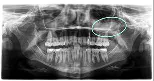 Image result for Sinus X Ray