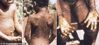 The duration of symptoms is typically 2 to 5 weeks. Britain Hit By Monkeypox Two Patients In North Wales Test Positive For Killer Virus Salten News