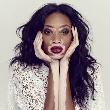 She was special guest at cinergia festival 2014 in lodz, along with peter greenaway, giuliano… Radio Taormina World Vitiligo Day Oggi Si Celebra La Giornata Mondiale Dedicata Alla Vitiligine