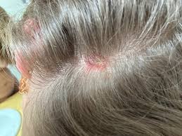 Image result for sores on the head in children