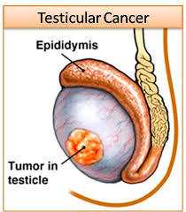 Symptoms causes treatment & prevention when to see a doctor references. Testicular Cancer Symptoms Treatment Testicular Self Examination