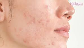 Jerawat bisa terjadi dibagian tubuh mana saja termasuk bagian punggung yang tidak terlihat. Cara Menghentikan Acne Dan 7 Petua Elak Kulit Yang Rengsa Kemerahan Terus Merebak Hijabista