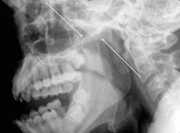 Image result for Jaw Dislocation