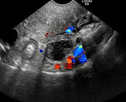 Ovarian cancer is the most common cause of cancer death from gynecologic tumors in the united states. Pelvic Ultrasound In Houston For Ovarian Cancer Screening