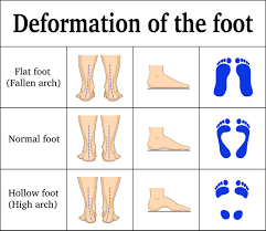 How To Fix Flat Feet