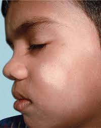 These patches may be lighter or darker in color than the surrounding skin and most commonly affect the trunk and shoulders. Jaypeedigital Ebook Reader
