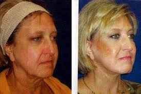 Our philosophy has always been to emphasize quality, design, service and value. Before And After Lifestyle Lift Image Facelift Info Prices Photos Reviews Q A