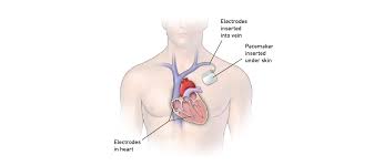 Pacemakers that use one wire lead to thread into the veins of the heart in any of the upper or lower chambers of the heart are called single chamber pacemakers. Pacemaker Temple Health