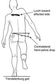 Trendelenburg Gait Physical Therapy Assistant Physical Therapy Massage Therapy