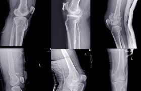 Image result for Fracture