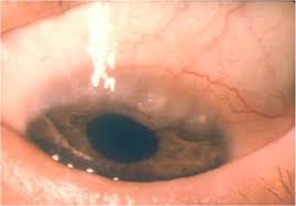 Image result for Vernal Conjunctivitis