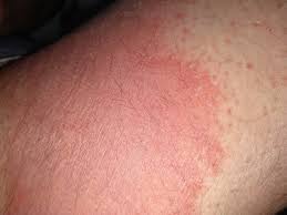 I Have An Embarrassing Rash On My Inner Thigh Any Advice As I Don T Want To Go To Gp In Current Climate Mumsnet