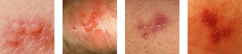 Generally, most of the individuals infected with hsv don't have any symptoms or experience very mild symptoms that go. The Psychology Of Comparison Pictures Of Genital Herpes Herpes Opportunity