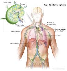 Non-Hodgkin Lymphoma Treatment - NCI